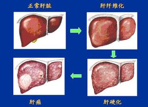 肝纤维化