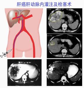 肝癌的治疗