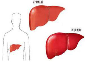 肝炎会传染吗