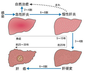 慢性肝炎